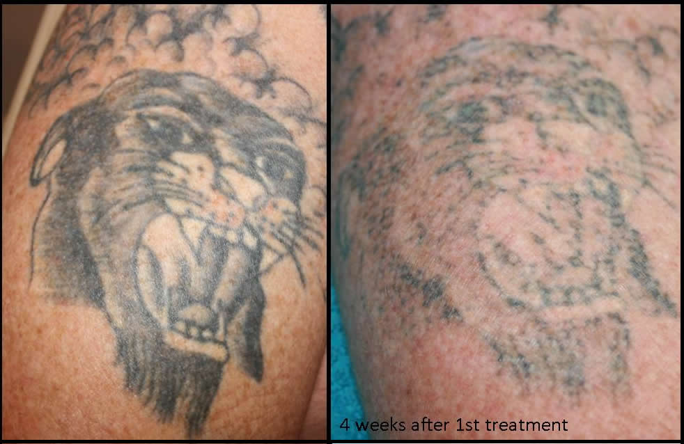 ... _Body_Rejuvenation_laser_tattoo_removal_tattoo_removal_tattoo2.jpg