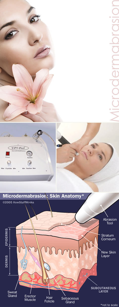 Microdermabrasion