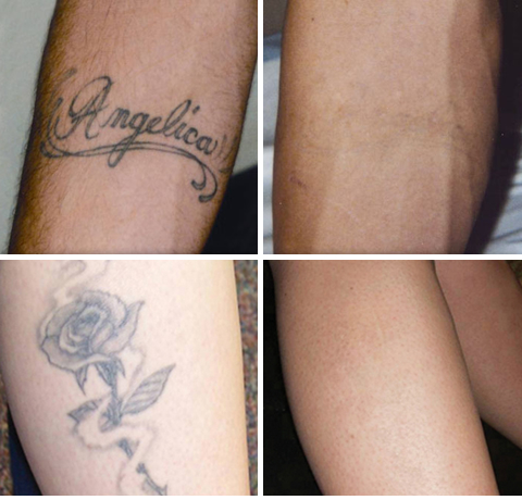 Tattoo Removal - Exhale Body Rejuvenation