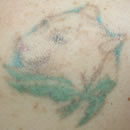 Tattoo removal