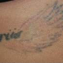 Tattoo removal