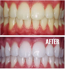 I-Smile Teeth Whitening