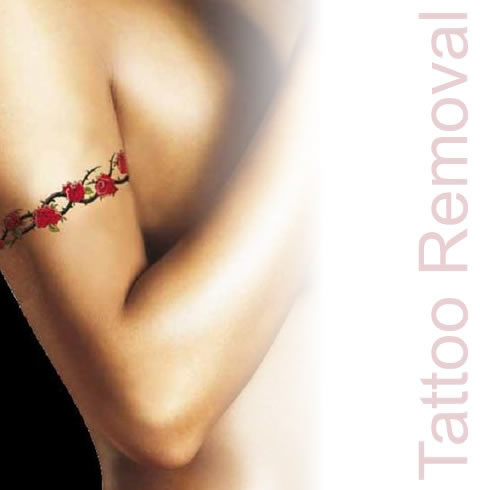 How Much Does Laser Tattoo Removal Cost? – Infinity Laser Spa